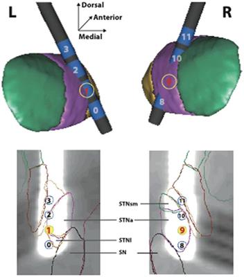 A single case report of STN-DBS for severe crack-cocaine dependence: double-blind ON vs. SHAM randomized controlled assessment